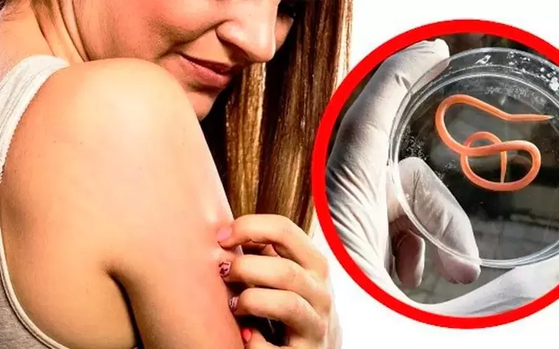 Démangeaisons et irritations dues aux parasites dans le corps