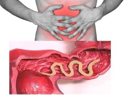 Les signes d'helminthiase chronique sont une maladie intestinale dyspeptique