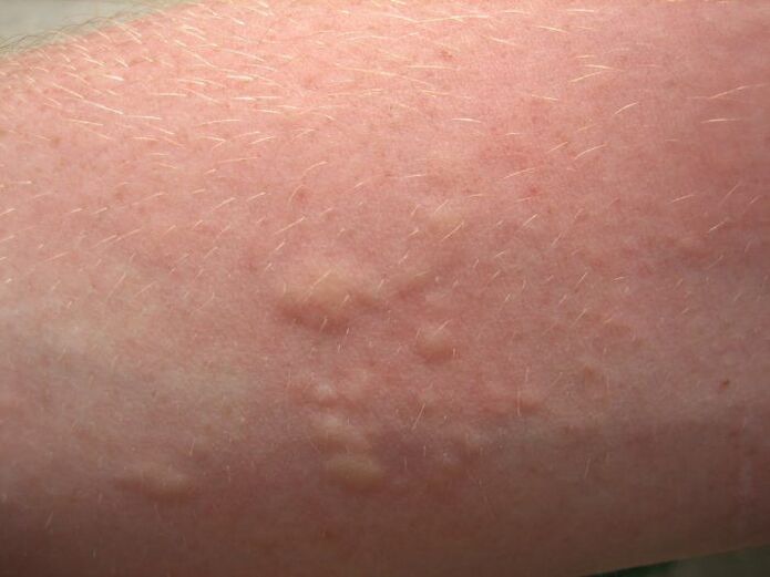 Des éruptions cutanées allergiques qui démangent peuvent être des symptômes d'ascaridiose
